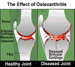 arthritis joint inflammation