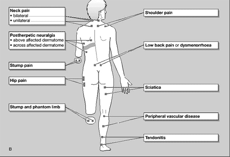 Sciatica+Tens+Placement+For+Sciatica Transcutaneous Electrostimulation 