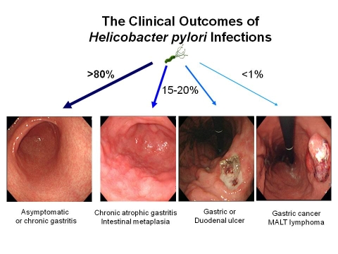 Can excessive flatulence indicate stomach cancer?