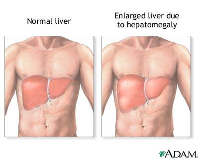 Enlarged Liver Symptoms