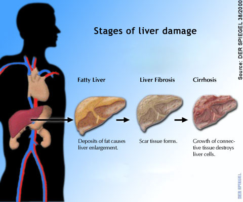 fatty-liver-cirrhosis.jpg